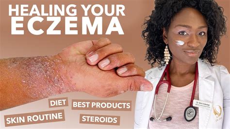 Eczema Face African American