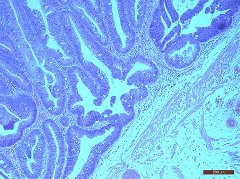 Histopathological image of the tissue showing tubular villous adenoma ...