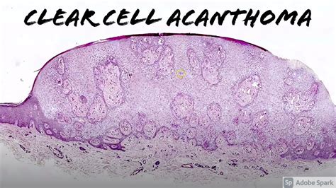 Clear Cell Acanthoma with PAS Stain: 5-Minute Pathology Pearls - YouTube