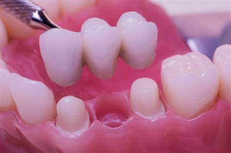 5 Common Dental Bridge Problems and How to Fix Them