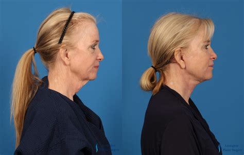 Fat Transfer – Face Before and After Pictures: Patient 4