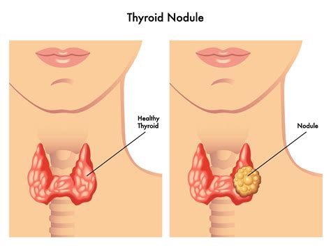 Thyroid Nodule Biopsy and Minimally Invasive Surgery - Advanced ENT ...