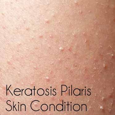 Keratosis Pilaris (Bumps on Skin) - Babywise Mom