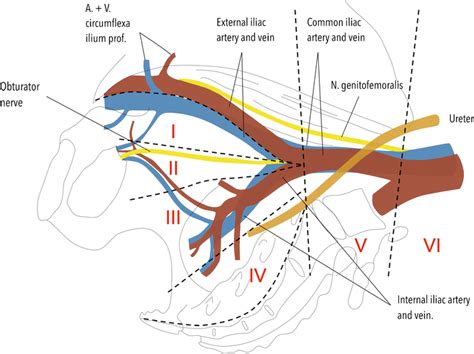 Anatomical regions involved in lymph node dissection. I external iliac... | Download Scientific ...