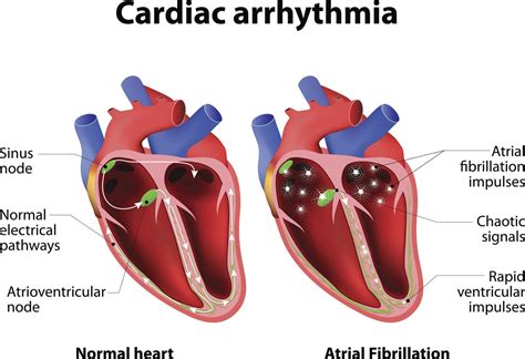 What Does Atrial Fibrillation Look Like