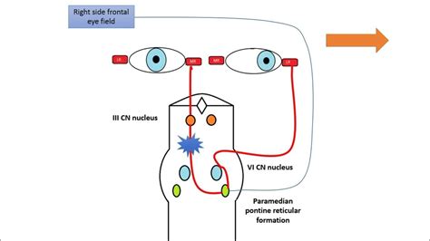 Internuclear ophthalmoplegia - YouTube