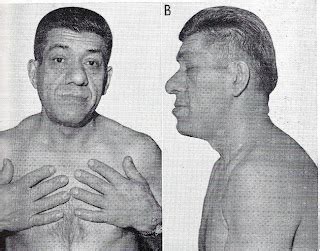 7 Nursing Diagnosis for Acromegaly