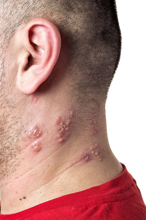 Shingles: Are You At Risk? | Medical Alert | LifeFone