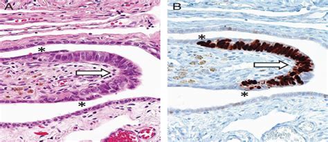 The Origin and Pathogenesis of Epithelial Ovarian Cancer: A... : The American Journal of ...