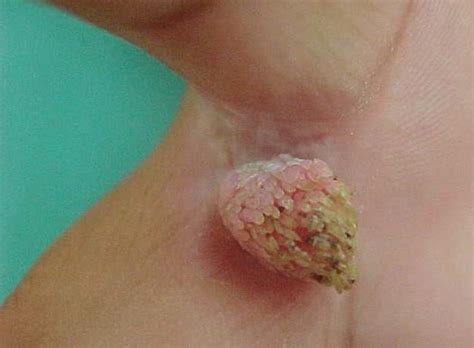 How to Get Rid of Digitate Warts – Wart Removal Help