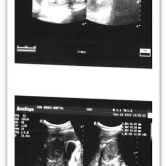 Ultrasound images showed liver hydatid cyst and dilated CBD. | Download ...