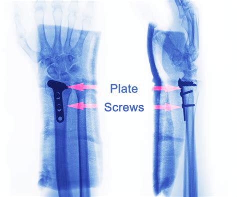 First Aid for Fractures