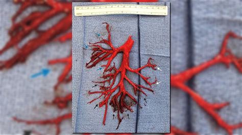 Man's 'extreme bout of coughing' forces out blood clot in shape of lung ...