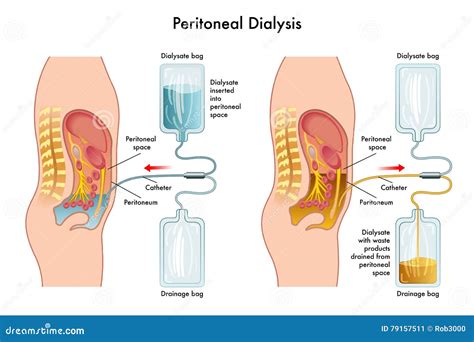 Dialysis Cartoons, Illustrations & Vector Stock Images - 4455 Pictures to download from ...