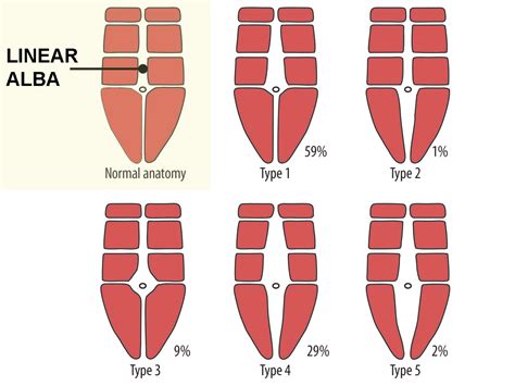 Sports Injury Bulletin - Anatomy - Mind the gap: Diastasis recti in postpartum athletes