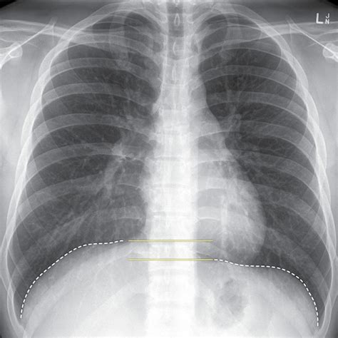 Normal Chest X Ray Labeled