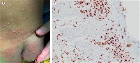 Blistering Langerhans cell histiocytosis - The Lancet Oncology