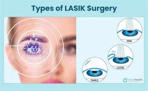 What are the Types of Lasik Laser Eye Surgery?