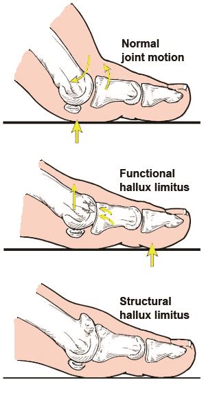 Why Your Big Toe Might be the Cause of Your Running Injuries (And How ...