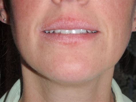 Common Causes of Recurrent Lip Rash (Cheilitis) - Zi Zai Dermatology Blog | Lip allergy, Chapped ...