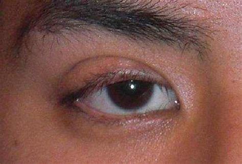 Drooping Eyelid: Symptoms, Causes and Treatment | EYExan.com