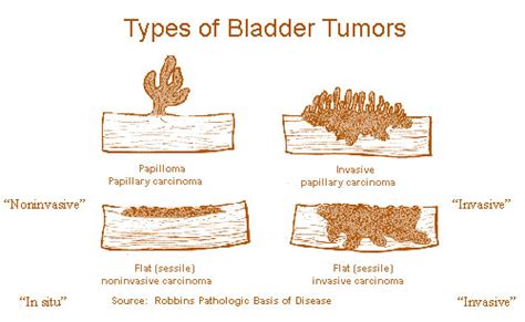 Tumor: Tumor In Bladder