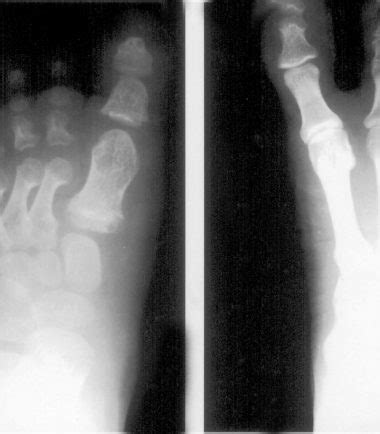 ACHALASIA | Buyxraysonline