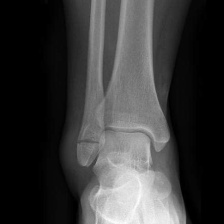 Weber classification of ankle fractures | Radiology Reference Article ...