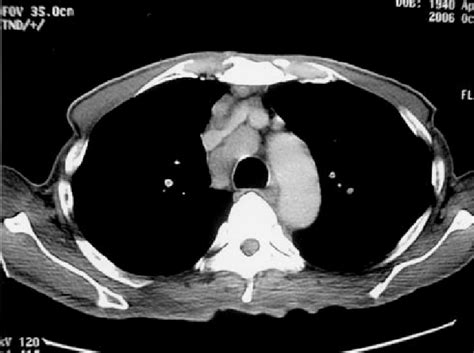 Mediastinal Lymph Nodes Ct Scan