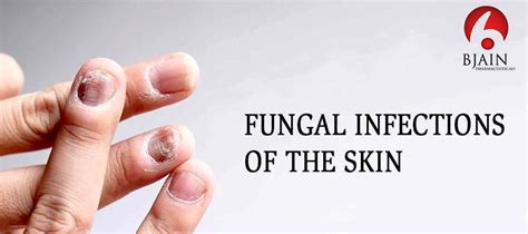 Fungal Skin Infections: Types, Symptoms and Treatments