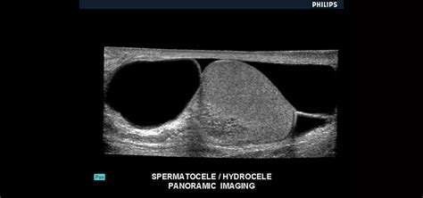 Spermatocele Histology