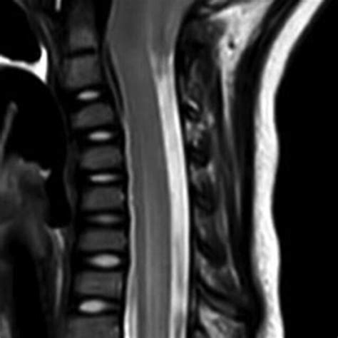 Preoperative magnetic resonance imaging (MRI) of the thoracic spine... | Download Scientific Diagram