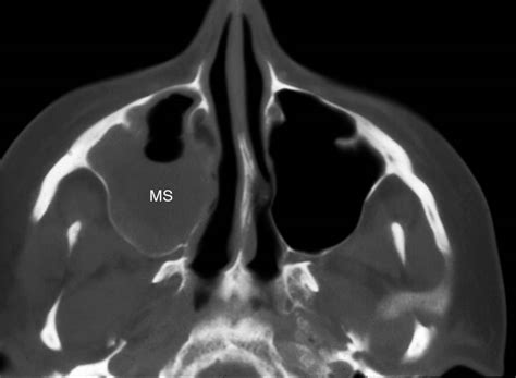 Acute Sinusitis X Ray