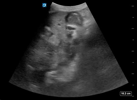 Hyperechoic Liver Masses | Emory School of Medicine