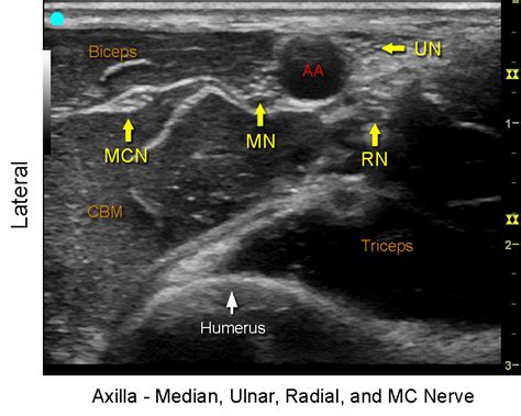 Axillary Brachial Plexus_Transducer position, US images and Crossection - NYSORA