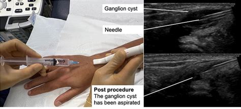 Ganglion cyst aspiration & steroid injection| Musculoskeletal ...