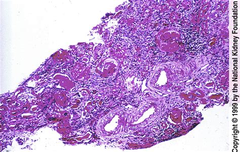 Hypertensive Nephrosclerosis - American Journal of Kidney Diseases