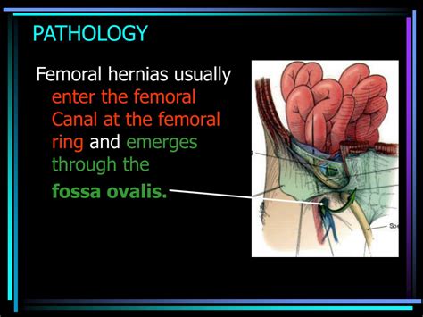 Femoral Hernia