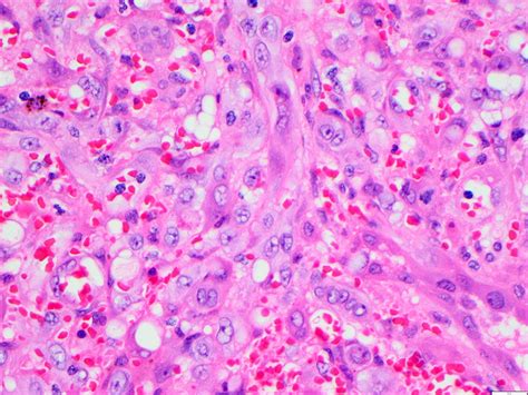 Epithelioid Angiosarcoma