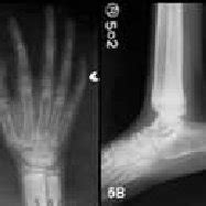 X-rays of both hands with AP view (5A) and ankles with lower leg... | Download Scientific Diagram
