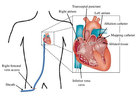 Central Venous Catheter Placement Procedure