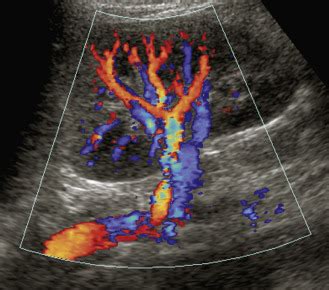 Duplex Ultrasound of Native Renal Vasculature | Radiology Key