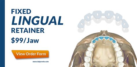 NEW Service Fixed Lingual Retainer Now Available on LabPronto.com!