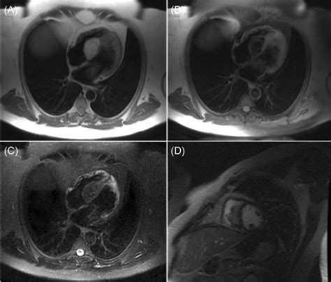 Cardiac MRI showing lipomatous hypertrophy of the interventricular ...