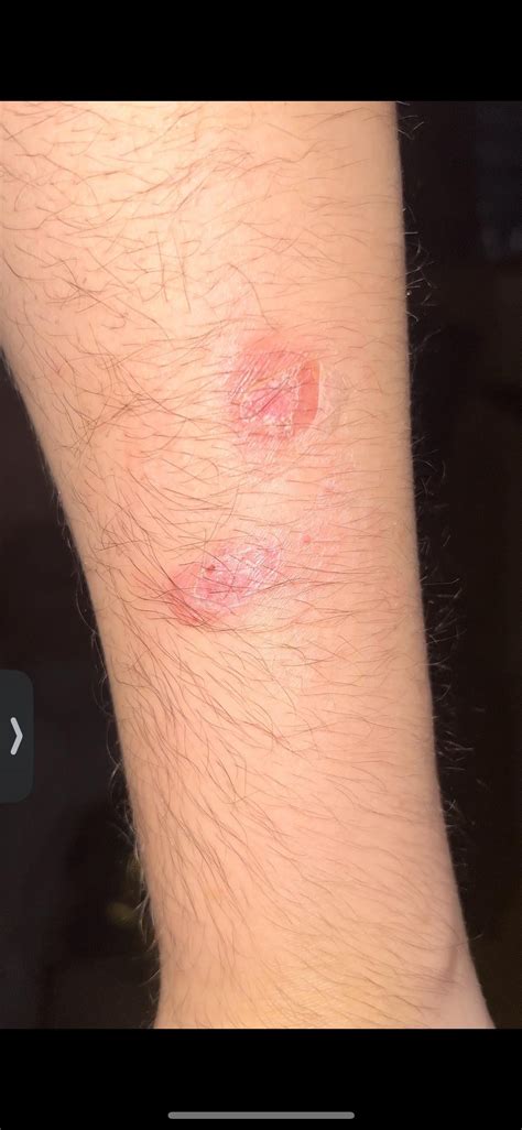 Rug burn or fungal infection? : r/medical