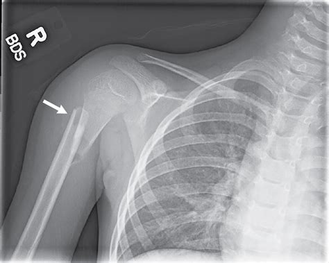 Humeral shaft fractures: Nothing funny about that! | Radiology Key