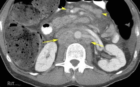 Ct Scan Abdomen Pelvisretroperitoneal Lymph Nodes Not Enlarged | The Best Porn Website