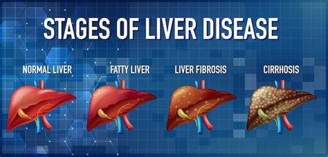 Free Vector | Stages of liver disease