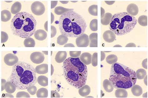 Hyposegmented Neutrophils