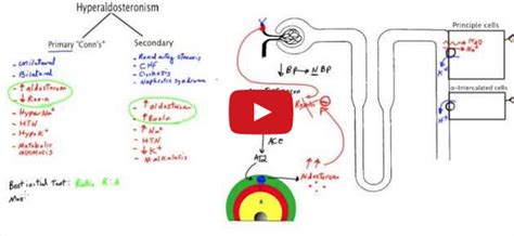 Conn’s syndrome - Video Lecture - Medical Institution